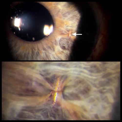 Artificial intraocular lens - iris claw design - retropupillary